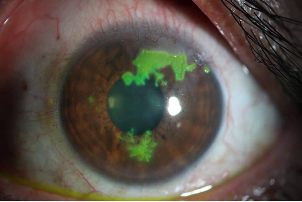 best cornea treatment in Habsiguda