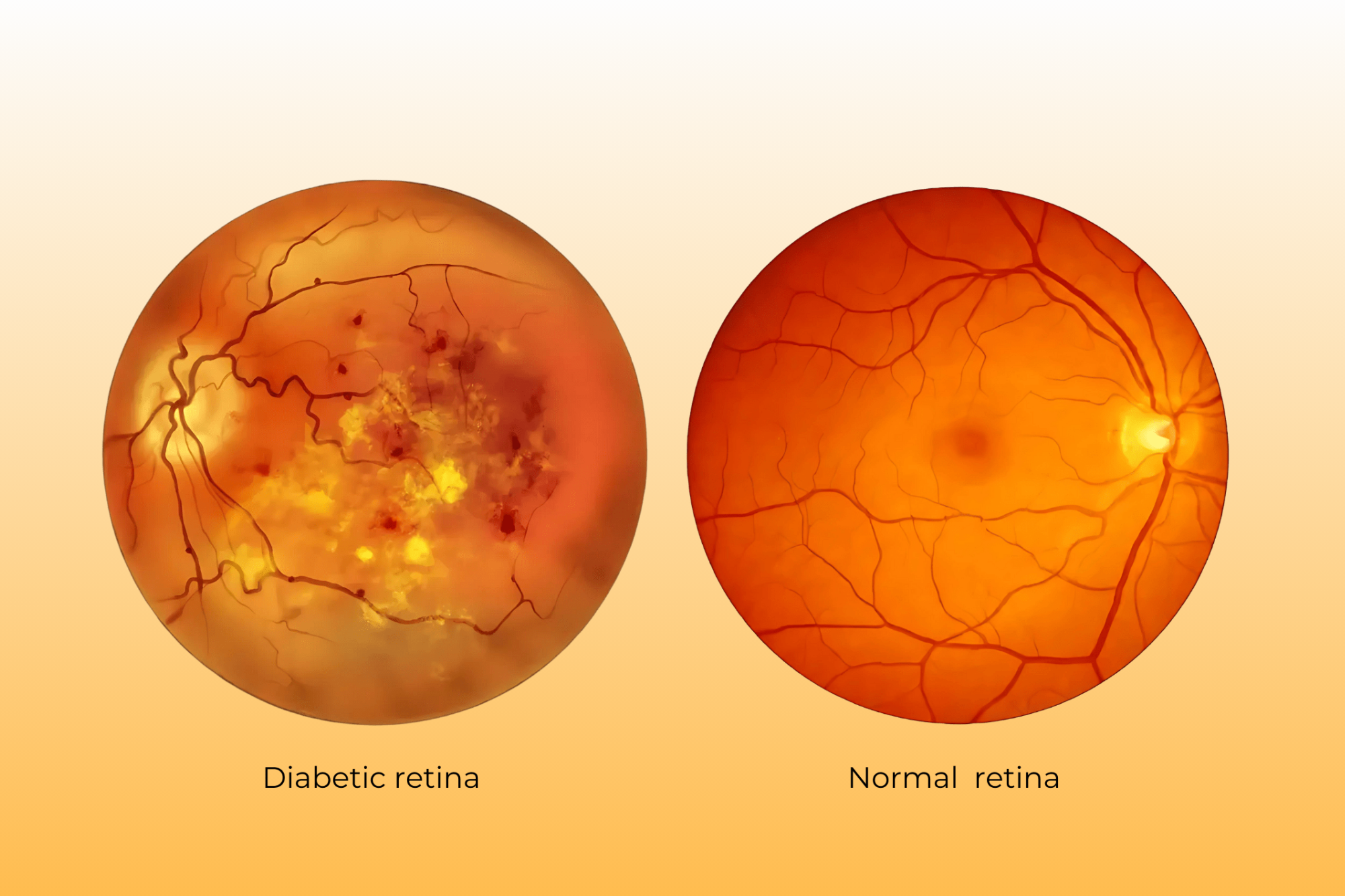 Best Diabetic Retinopathy in Habsiguda