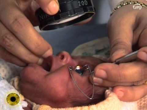 Retinopathy of prematurity (ROP) at Sai Nethralaya