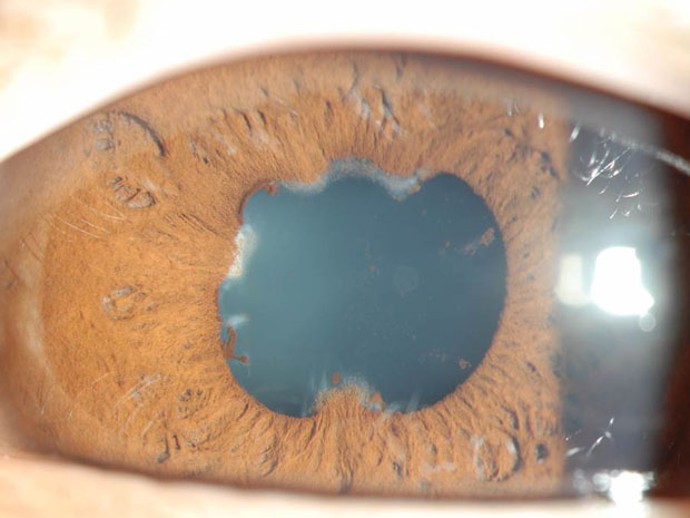 Best retina and uvea Surgery in Habsiguda