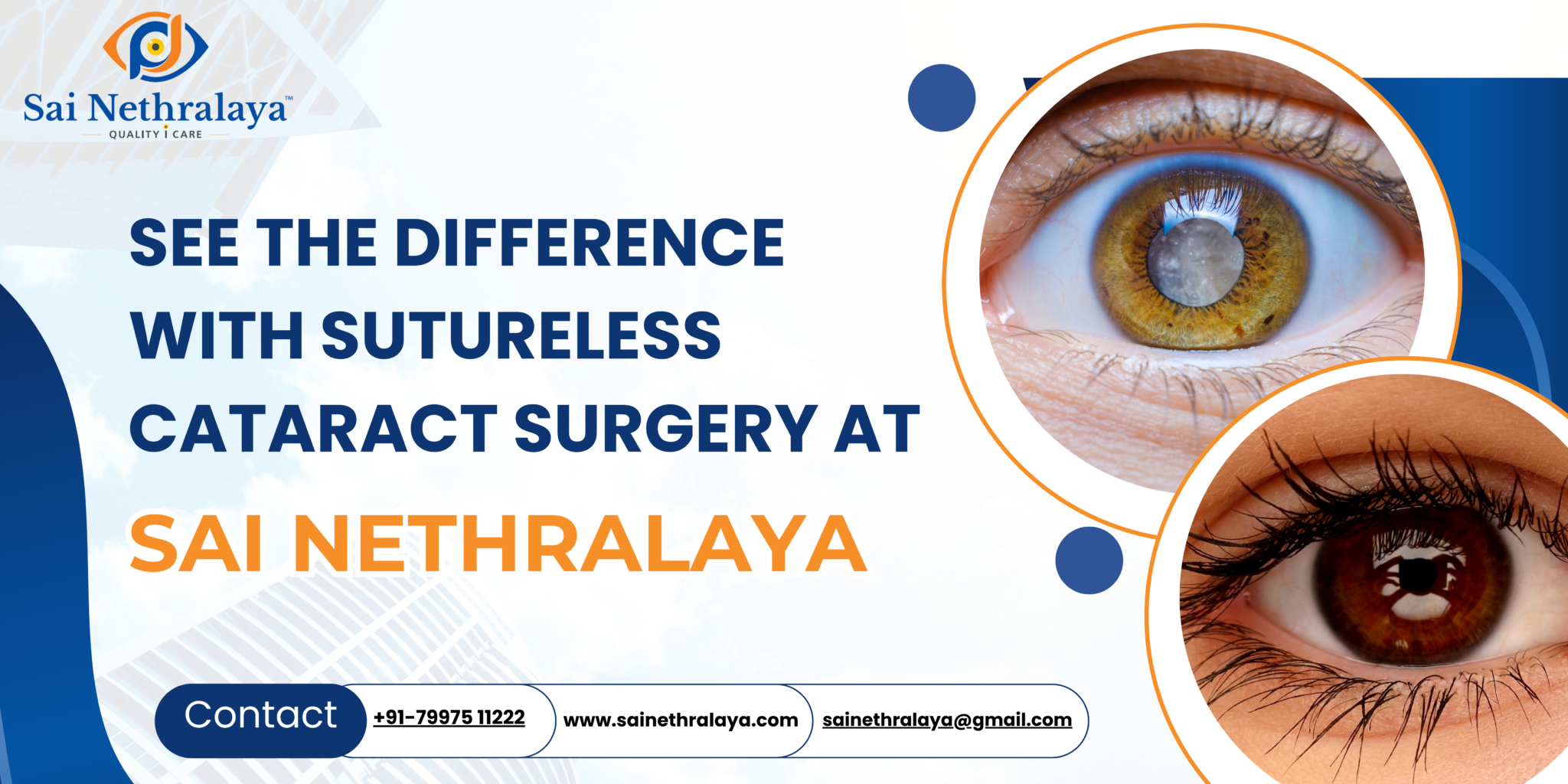 Sutureless Cataract Surgery: A Modern Solution at Sai Nethralaya