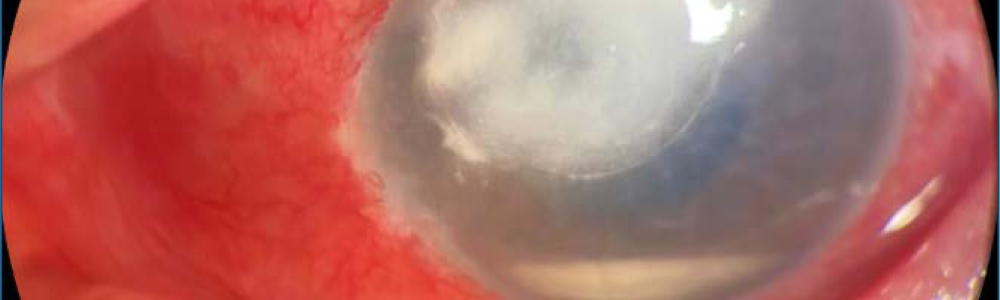 Best Cornea Surgery at Sai Nethralaya
